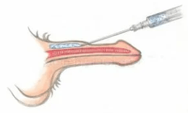 Mga injection sa hyaluronic acid